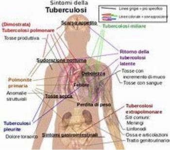 tubercolosi